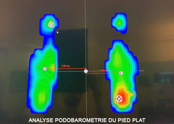 Analyse PODOBAROMETRIE PIED PLAT