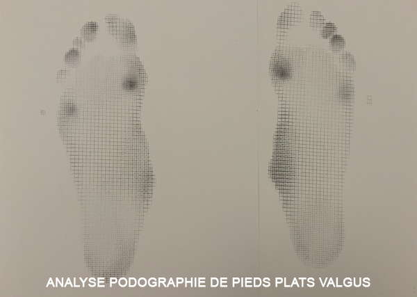 Analyse podographie de pieds plats valgus